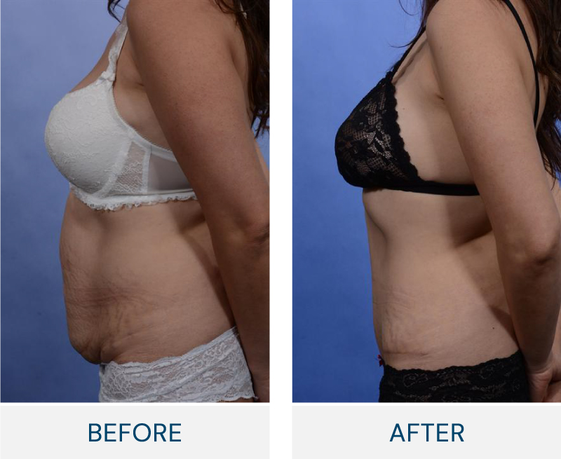 tummy tuck before and after