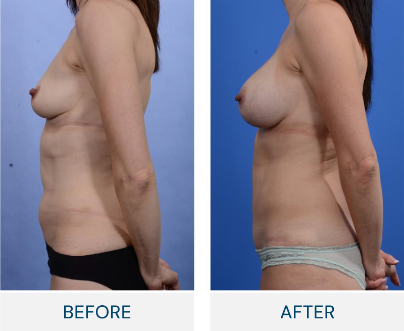 case 109 breast augmentation