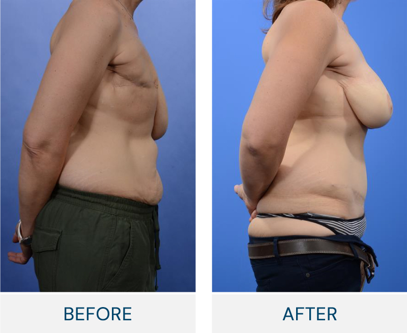 Breast Reconstruction case 118