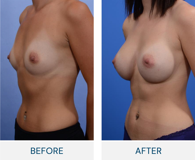 case 121 breast augmentation