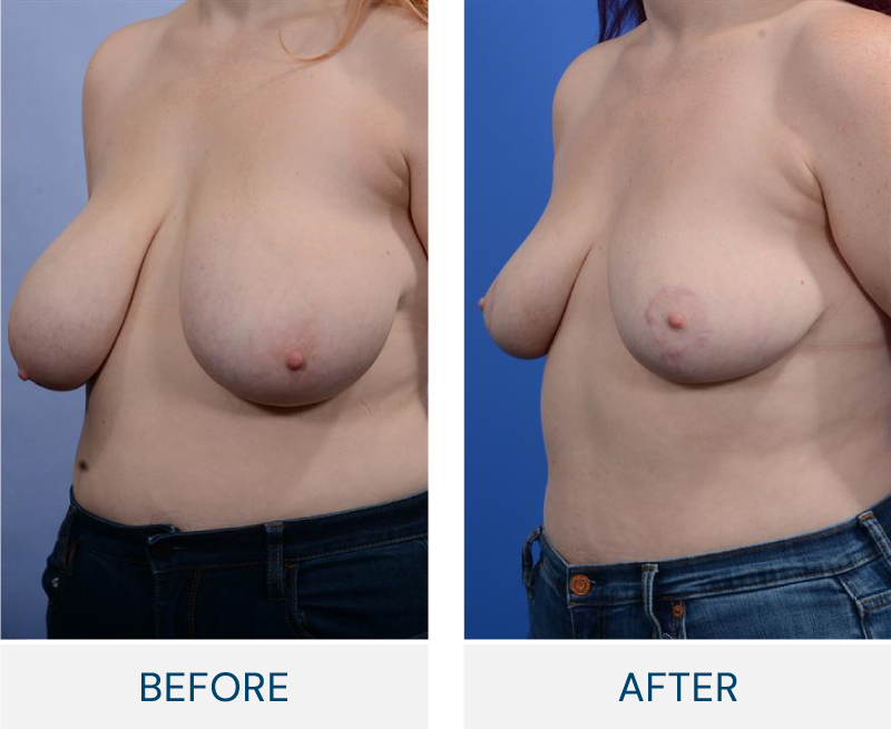 Breast Reduction case 128