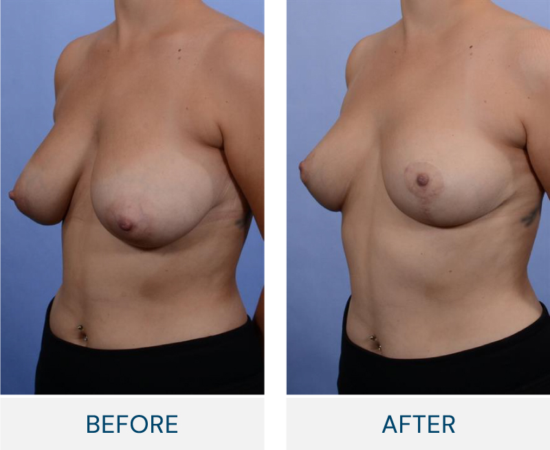 Breast Lift (Mastopexy) case 129