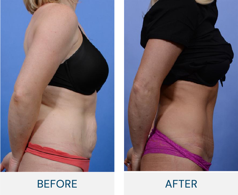 Tummy Tuck case 13