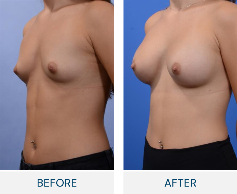 case 132 breast augmentation