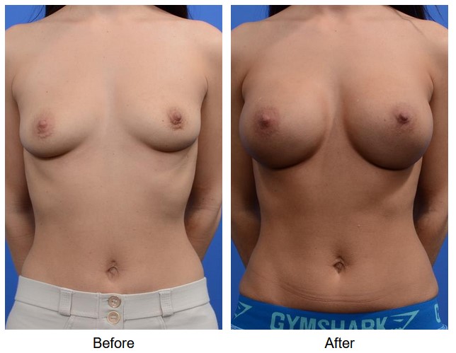 case 134 breast augmentation