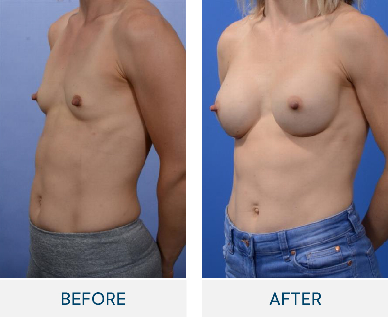 case 136 breast augmentation