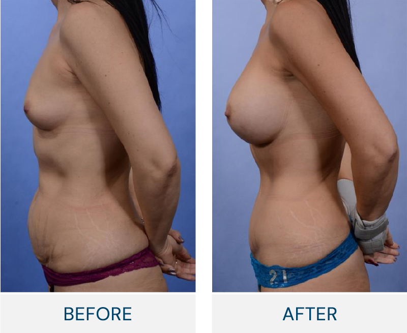 mommy makeover case 143