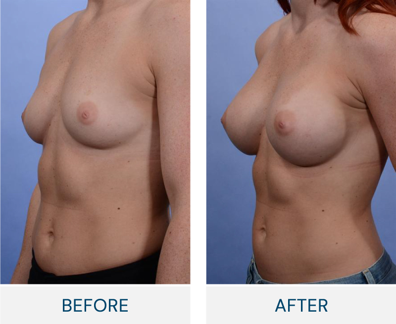 case 23 breast augmentation