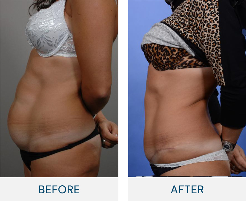 tummy tuck before and after