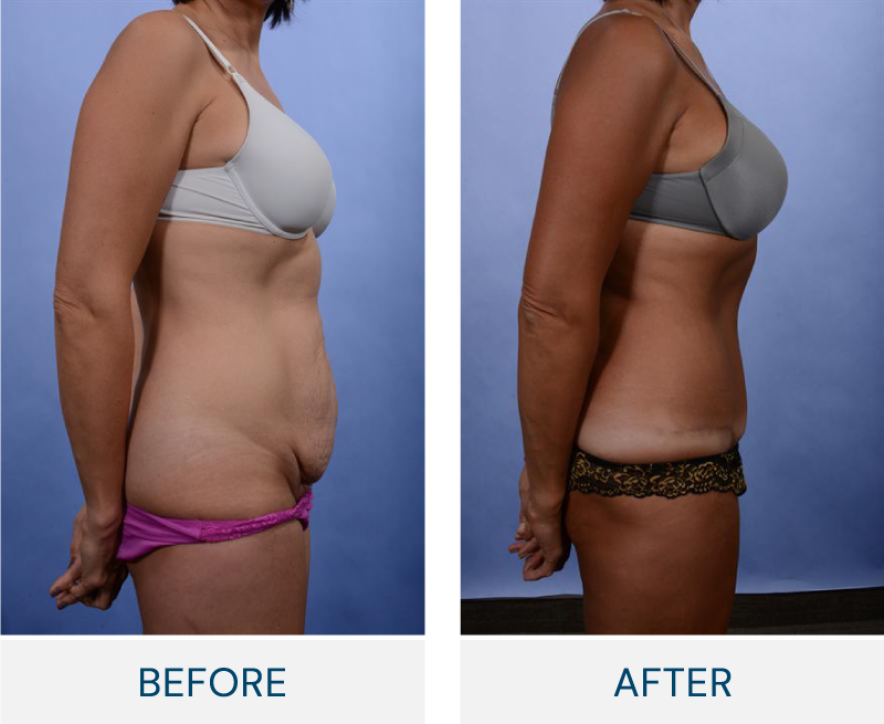 tummy tuck before and after