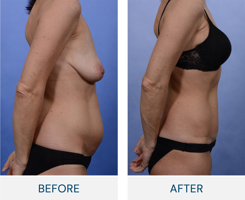 tummy tuck before and after
