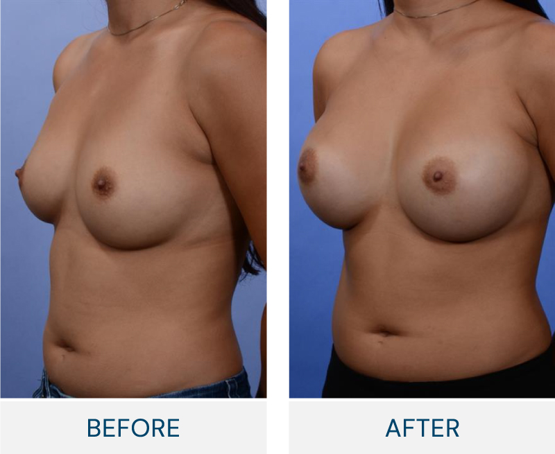 case 37 breast augmentation
