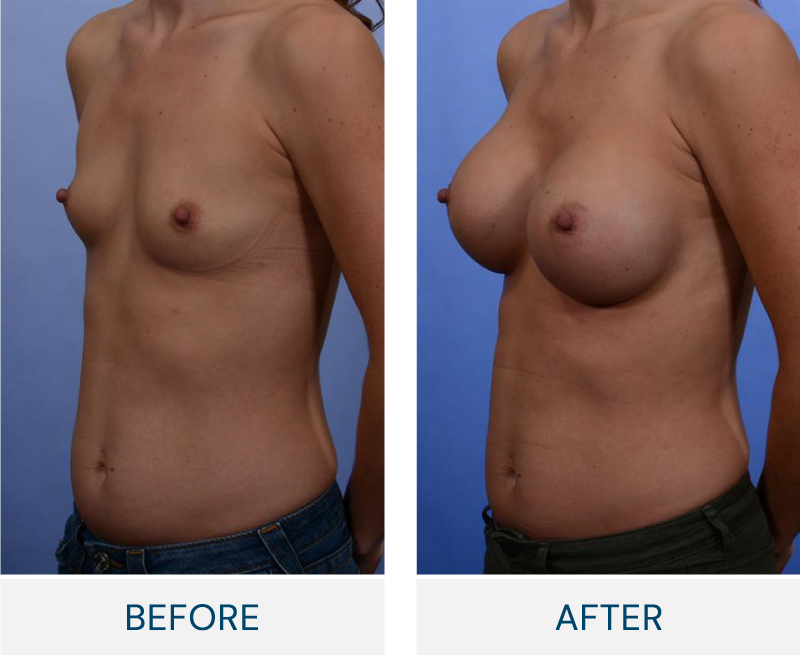 case 38 breast augmentation