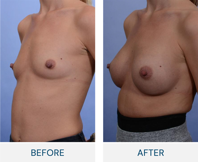 case 39 breast augmentation