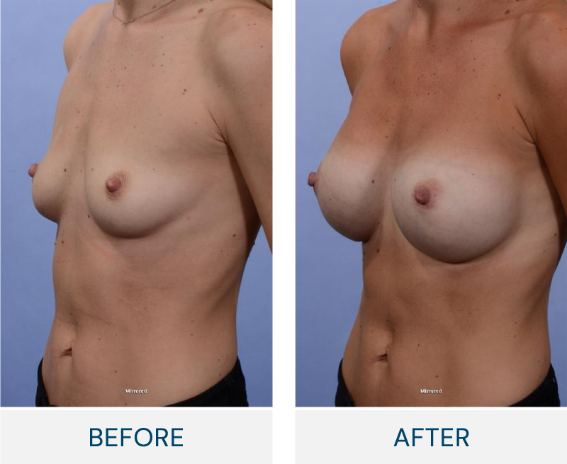 case 43 breast augmentation