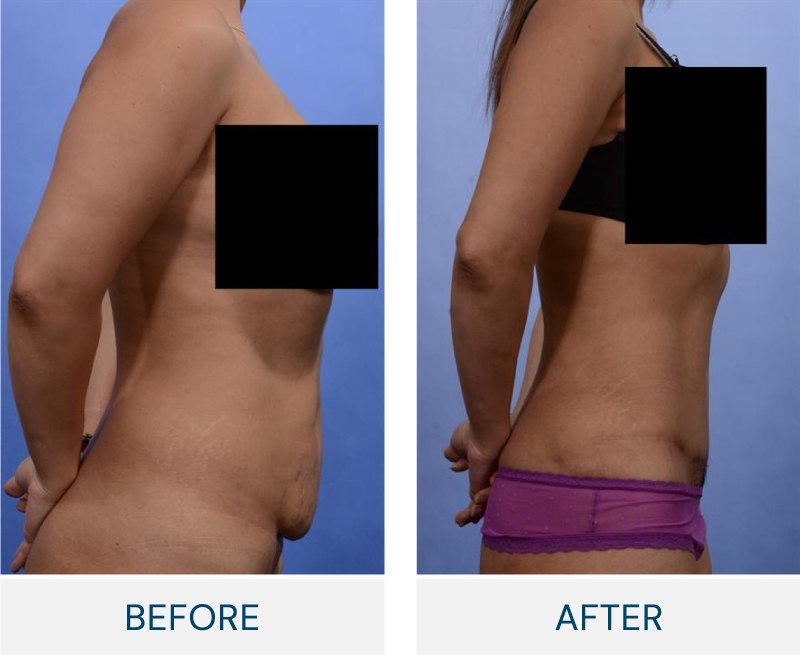 before and after case 47