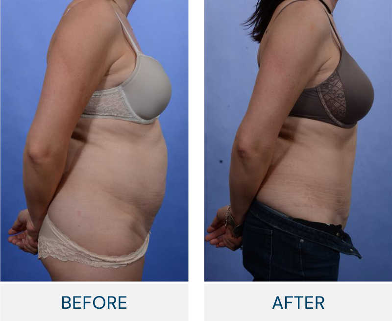 tummy tuck before and after