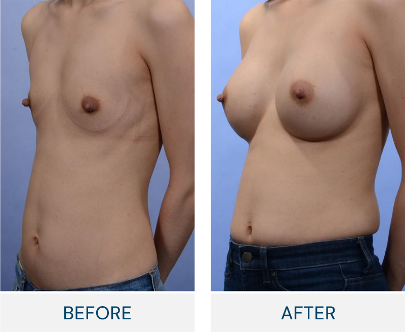 case 56 breast augmentation