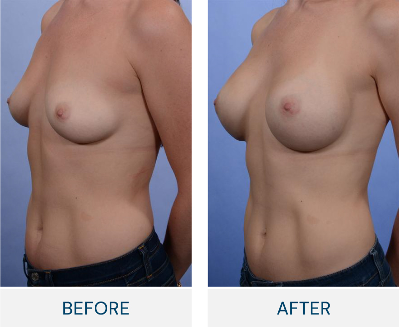 case 57 breast augmentation