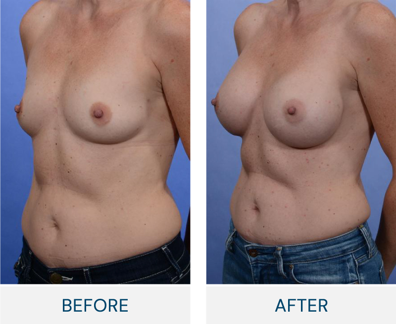 case 58 breast augmentation