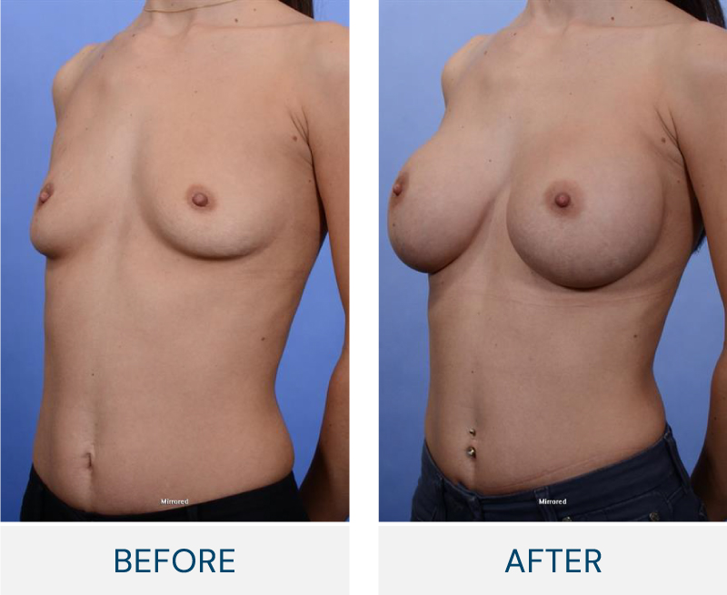 case 60 breast augmentation