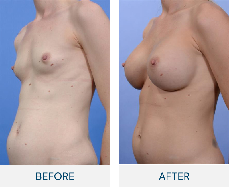 case 61 breast augmentation