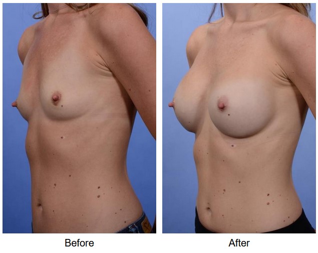 case 64 breast augmentation