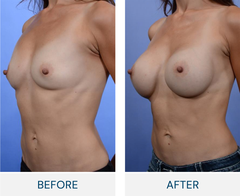 case 65 breast augmentation