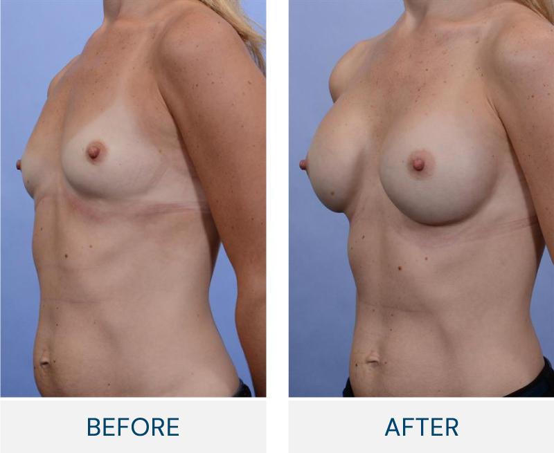 case 71 breast augmentation