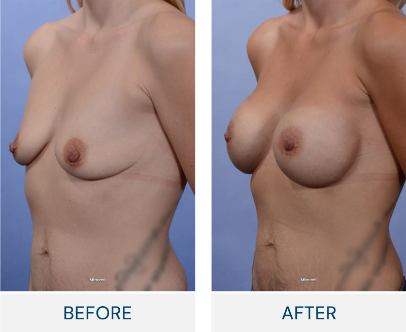 case 72 breast augmentation