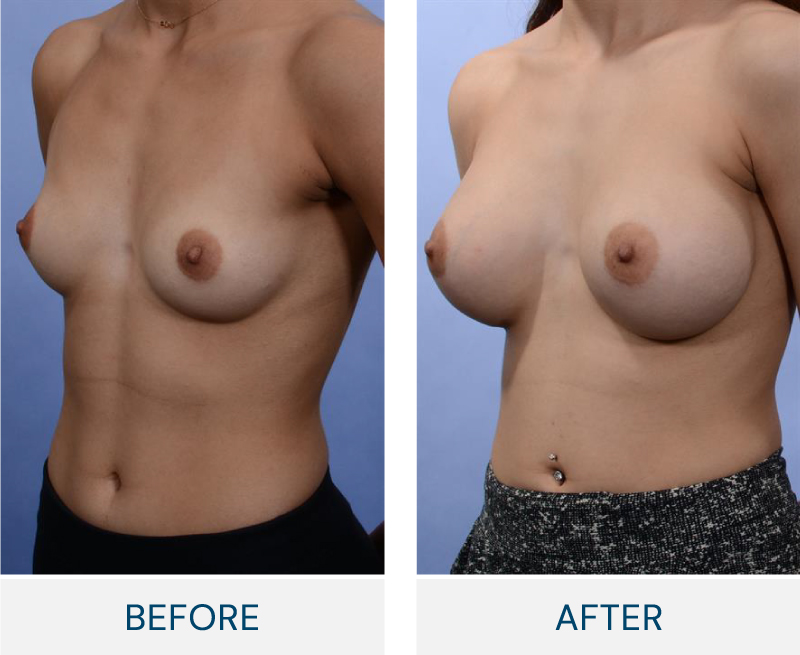 case 75 breast augmentation