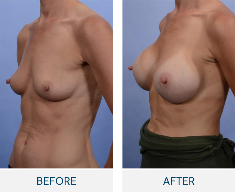case 8 breast augmentation