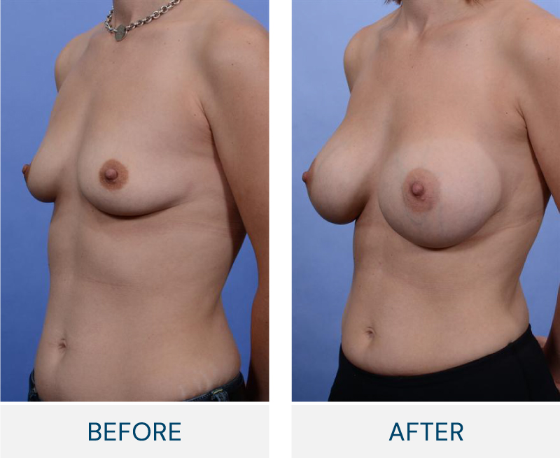 case 80 breast augmentation