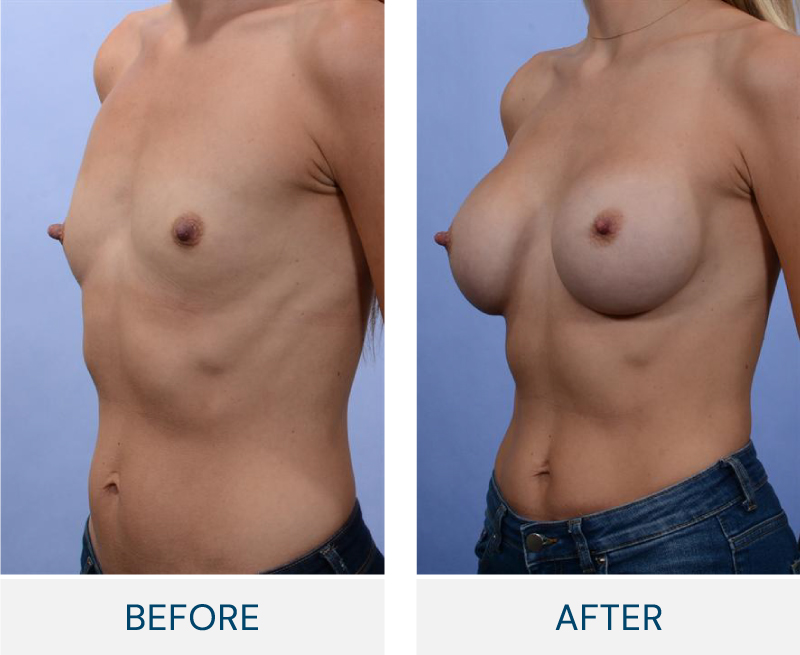 case 87 breast augmentation