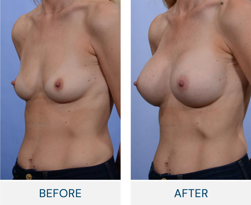 case 95 breast augmentation