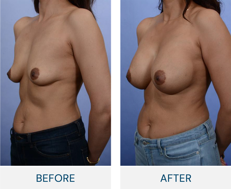 case 99 breast augmentation
