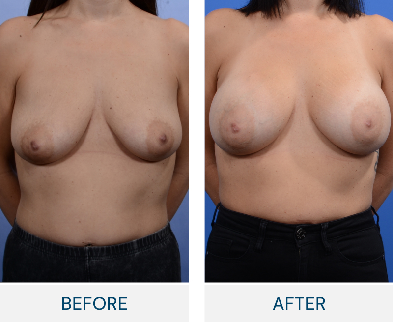 Breast Augmentation with Lift case