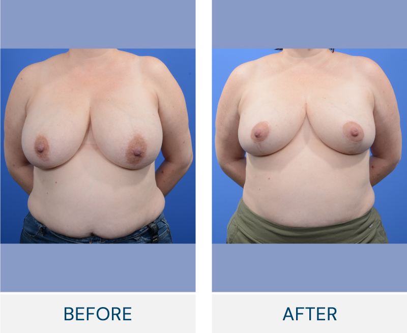 Breast Reduction case 131