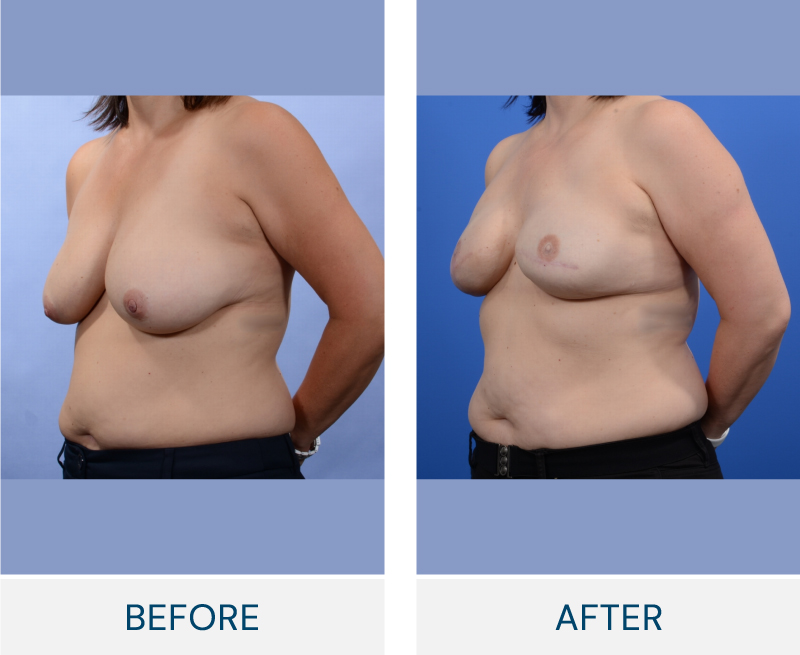 Breast Reconstruction case 118