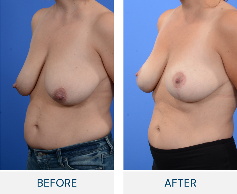 Breast Reconstruction case 118