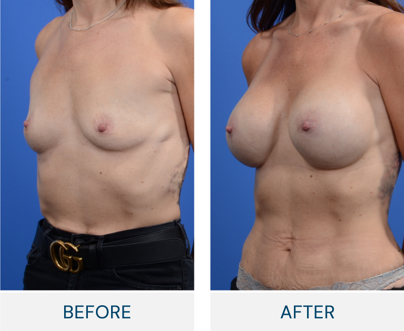 case 158 before after breast augmentation