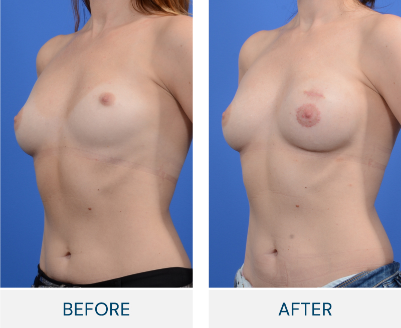 case 161 before after breast reconstruction