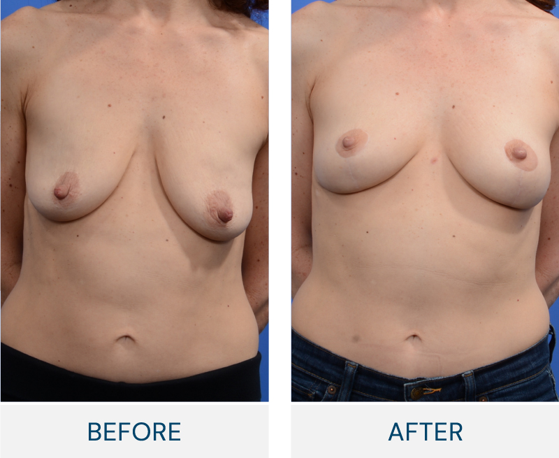 case 163 before after Bilateral Mastopexy (Breast Lift) with Nipple Reduction