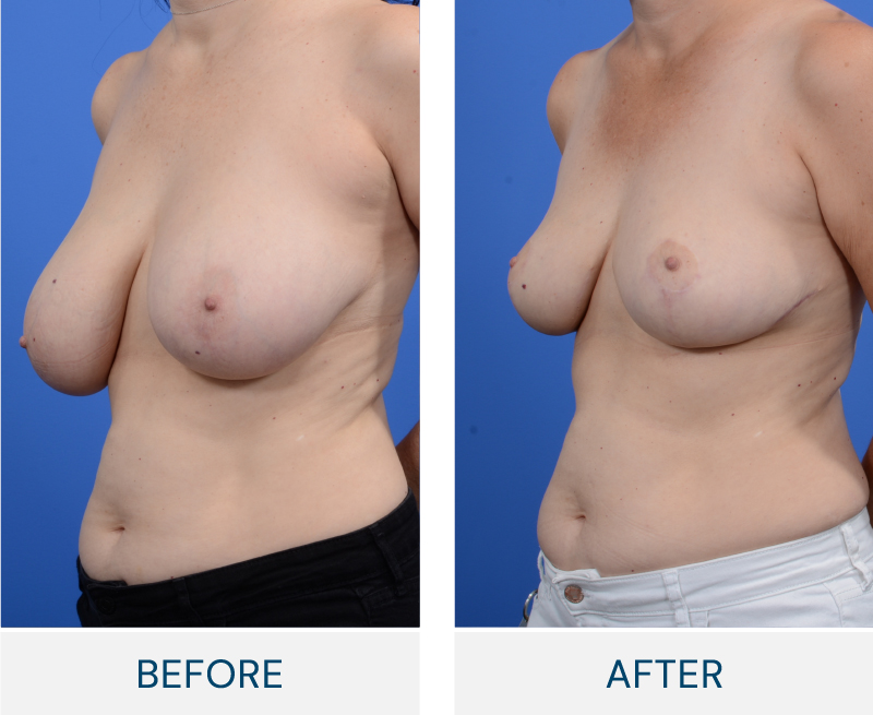 case 164 before after Bilateral Breast Reduction