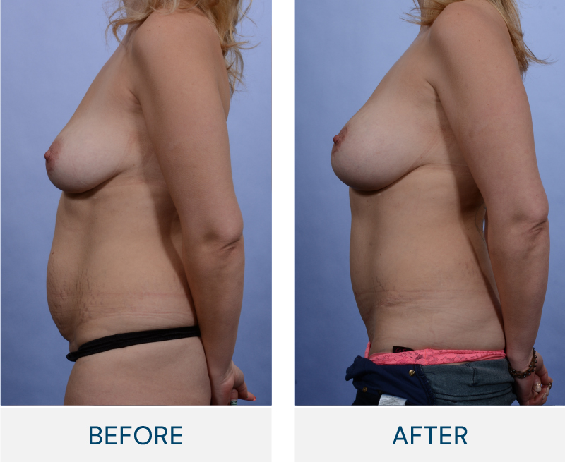 case 165 before after Abdominoplasty