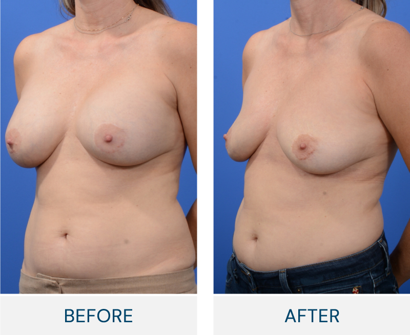 case 167 before after Bilateral Breast Implant Removal