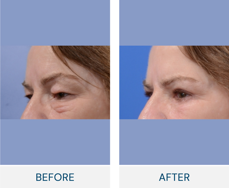 case 169 before after Bilateral Blepharoplasty Upper & Lower Lids