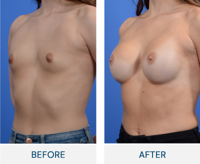 case 169 before after Bilateral Breast Augmentation
