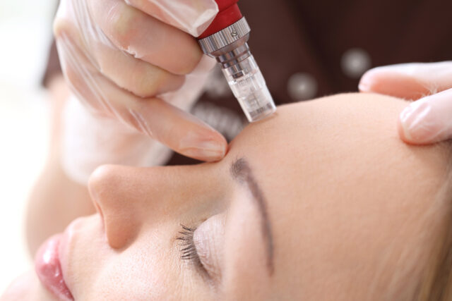 Microneedling Calgary Macleod Trail Plastic Surgery