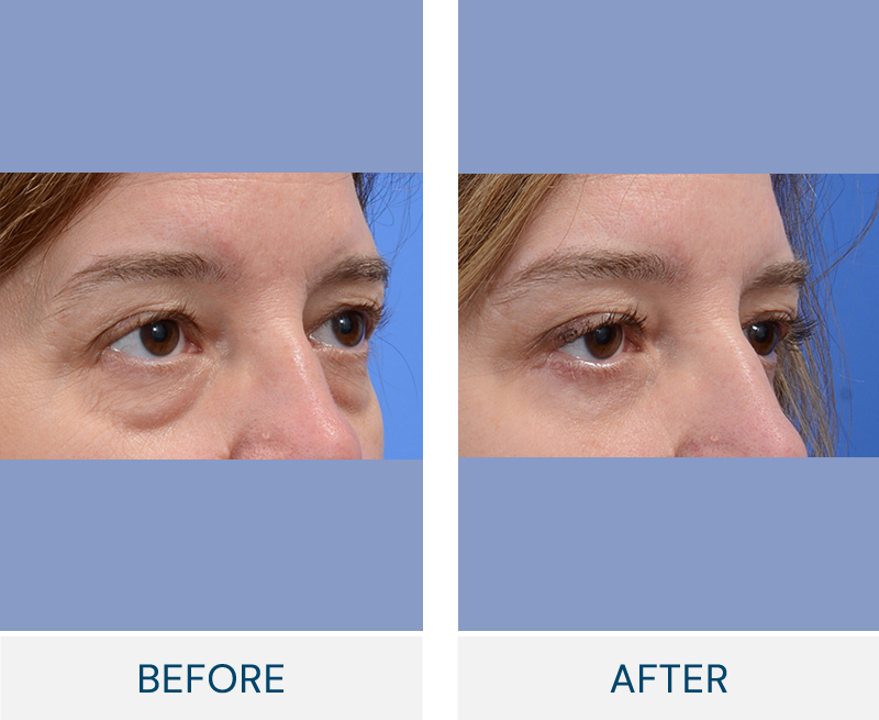 Lower Blepharoplasty
